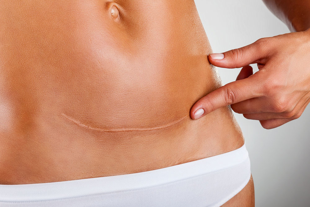 Lifestyle Changes for Managing Ovarian Cancer