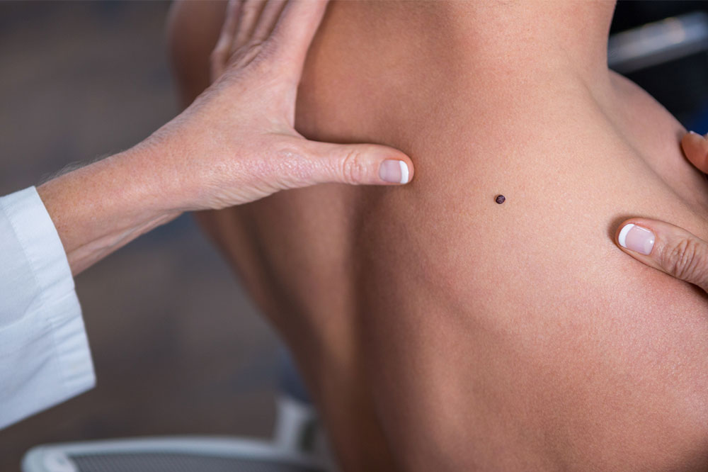 Lifestyle Changes to Manage Melanoma