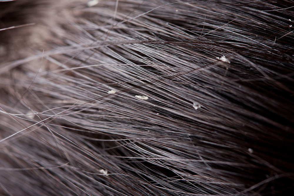 Natural Remedies to Get Rid of Flaky Scalp